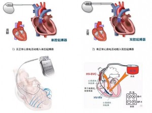 心脏起搏器植入：终身携带还是短期需求？探讨起搏器安装的长期影响