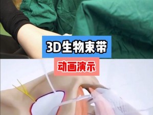 3d 生物束带紧缩术效果因人而异，一般可维持 5-10 年