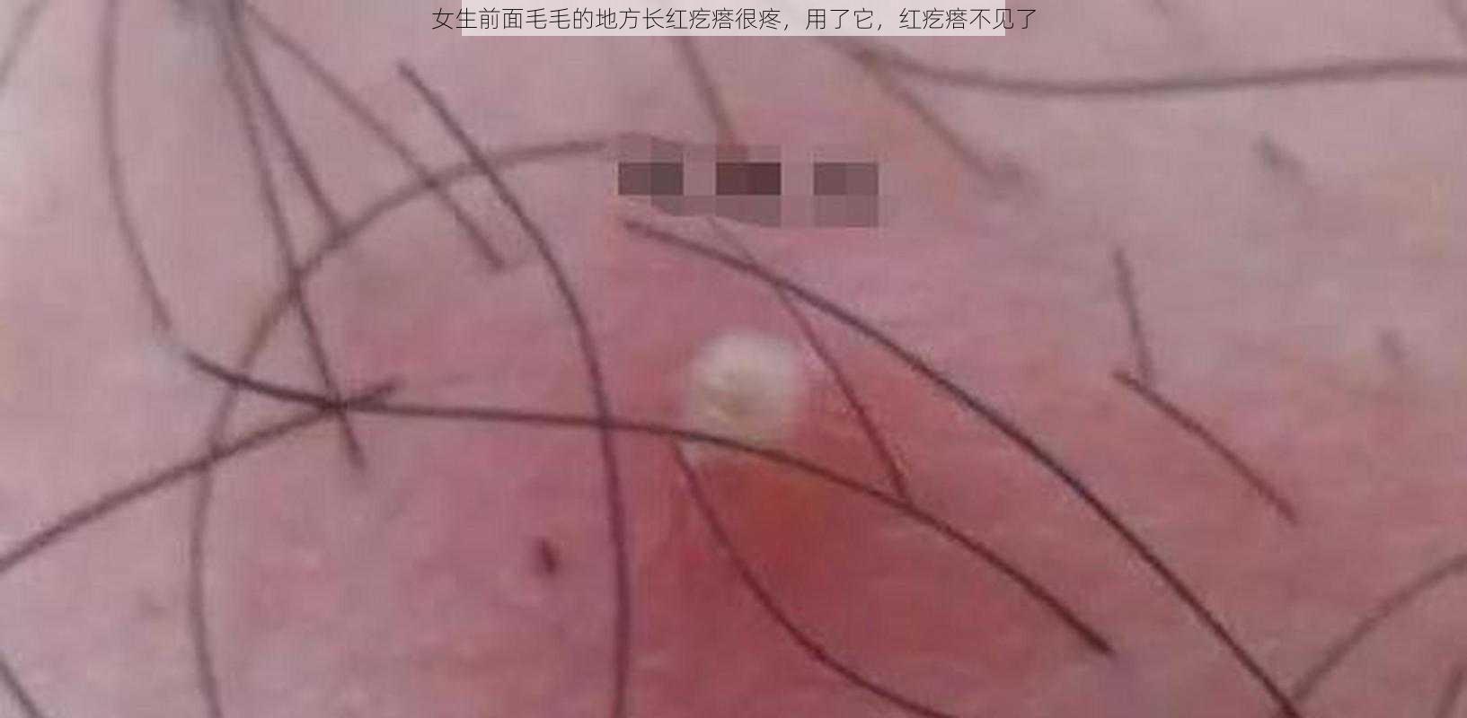 女生前面毛毛的地方长红疙瘩很疼，用了它，红疙瘩不见了