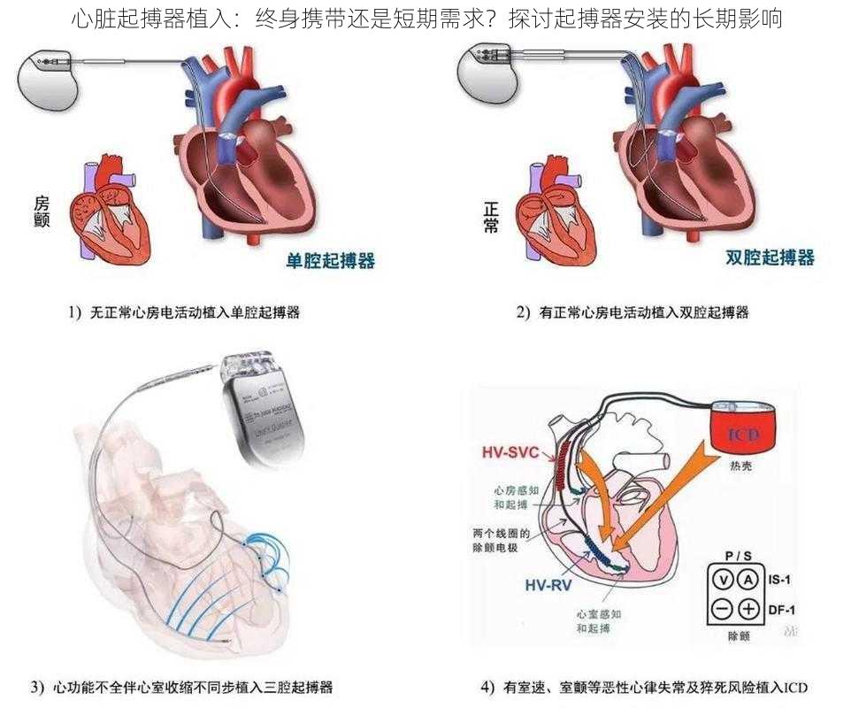 心脏起搏器植入：终身携带还是短期需求？探讨起搏器安装的长期影响